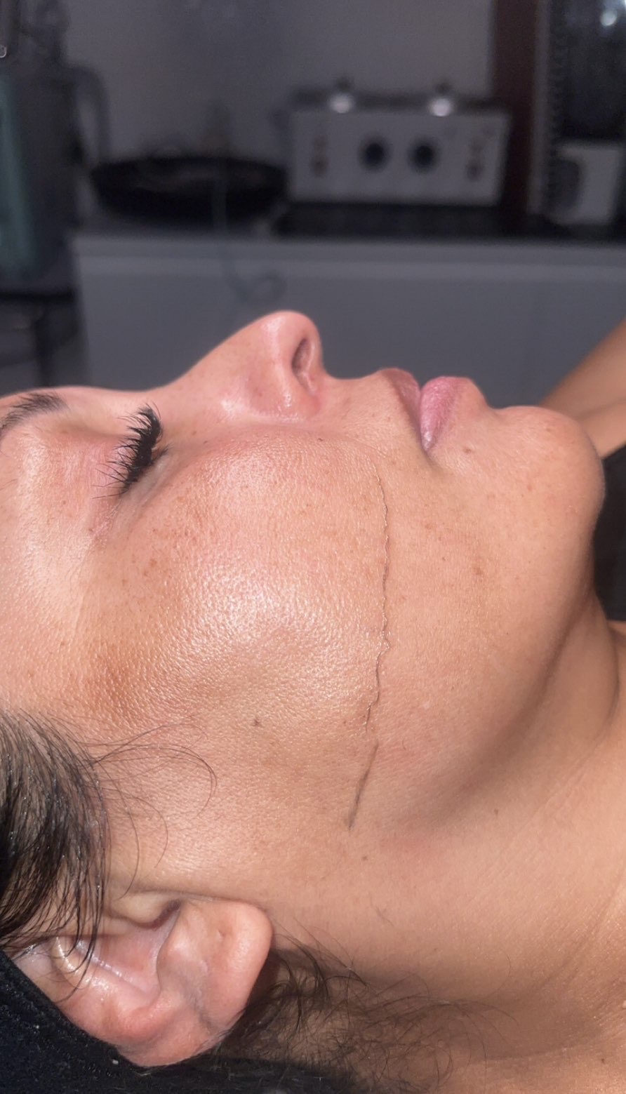 Before: side profile of the client's cheek and jaw during a facial, with a visible line where part of the skin has already been treated.